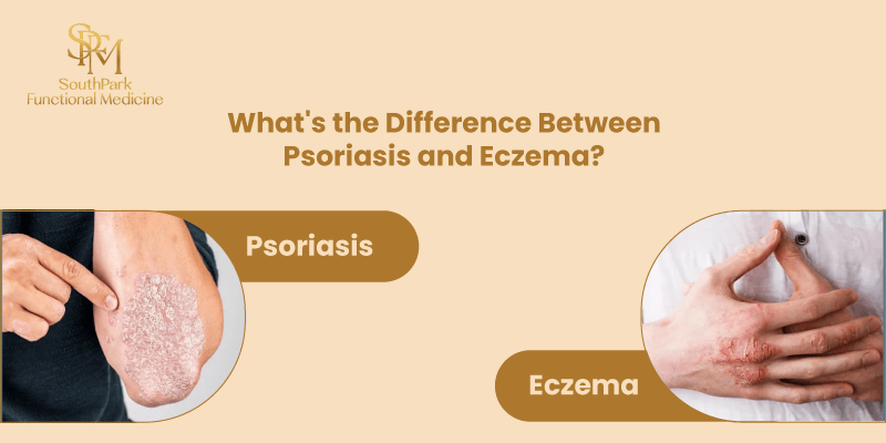What’s the Difference Between Psoriasis and Eczema?